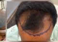सेलूत केश प्रत्यारोपणाची यशस्वी शस्त्रक्रिया