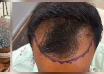 सेलूत केश प्रत्यारोपणाची यशस्वी शस्त्रक्रिया