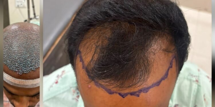 सेलूत केश प्रत्यारोपणाची यशस्वी शस्त्रक्रिया