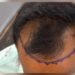 सेलूत केश प्रत्यारोपणाची यशस्वी शस्त्रक्रिया